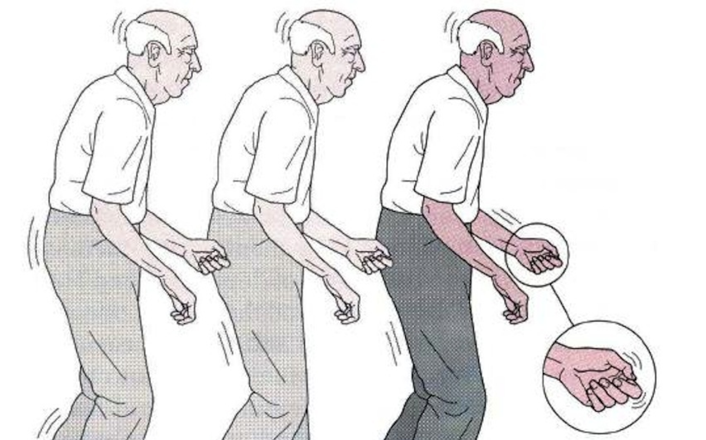 Parkinson’s disease