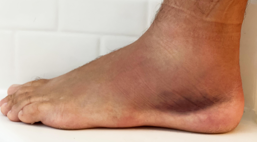 Reduce Pain And Swelling